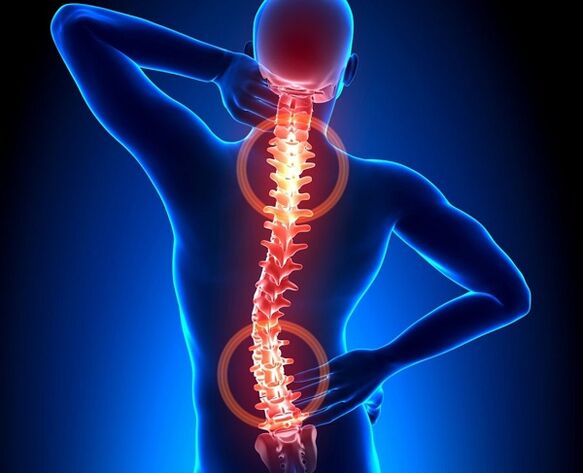 dolore alla colonna vertebrale con osteocondrosi