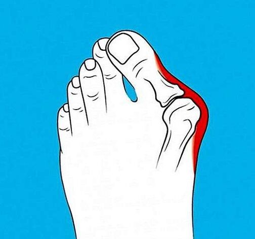 artrosi dell'articolazione sul dito del piede