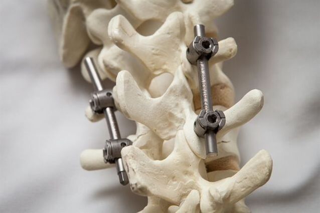 fissazione della colonna vertebrale osteocondrosi del collo