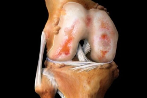 danno cartilagineo nell'artrosi del ginocchio