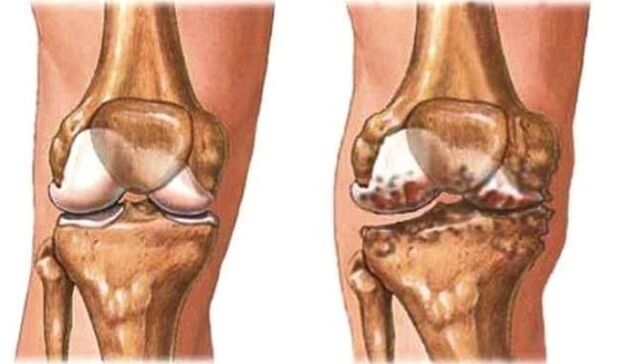 ginocchio sano e artrosi del ginocchio