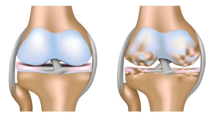 cartilagine sana e danni all'articolazione del ginocchio con artrosi