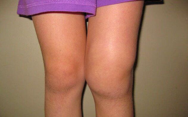 ginocchio gonfio a causa dell'artrosi
