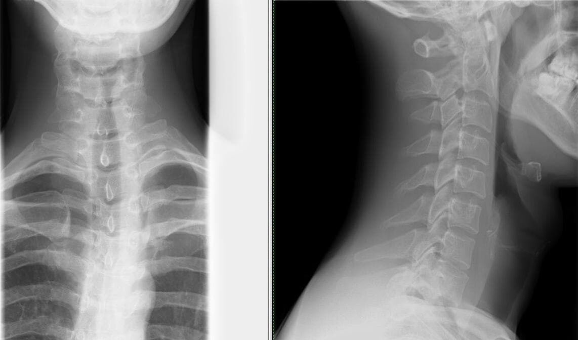 La radiografia della colonna vertebrale è un metodo semplice ed efficace per diagnosticare l'osteocondrosi