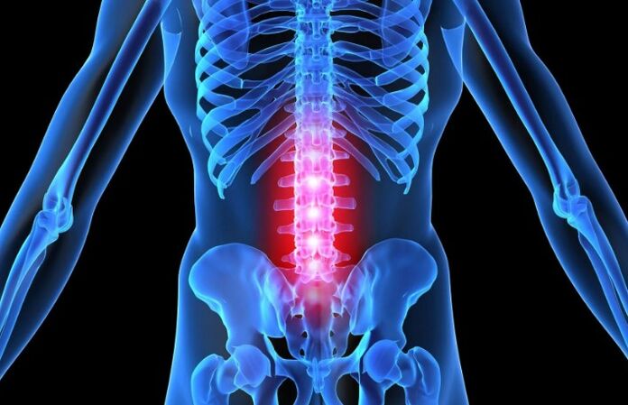 Osteocondrosi della regione lombare