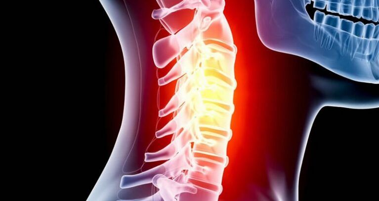Infiammazione della regione cervicale