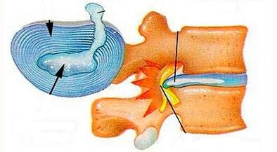 Caratteristiche dello sviluppo dell'osteocondosi cervicale