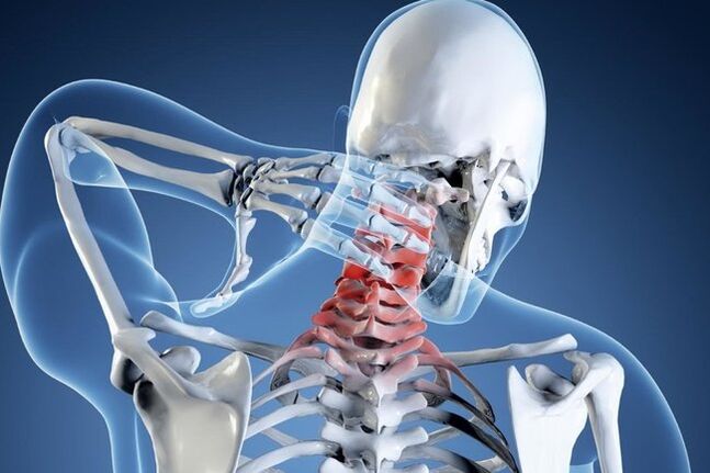 osteocondrosi del rachide cervicale